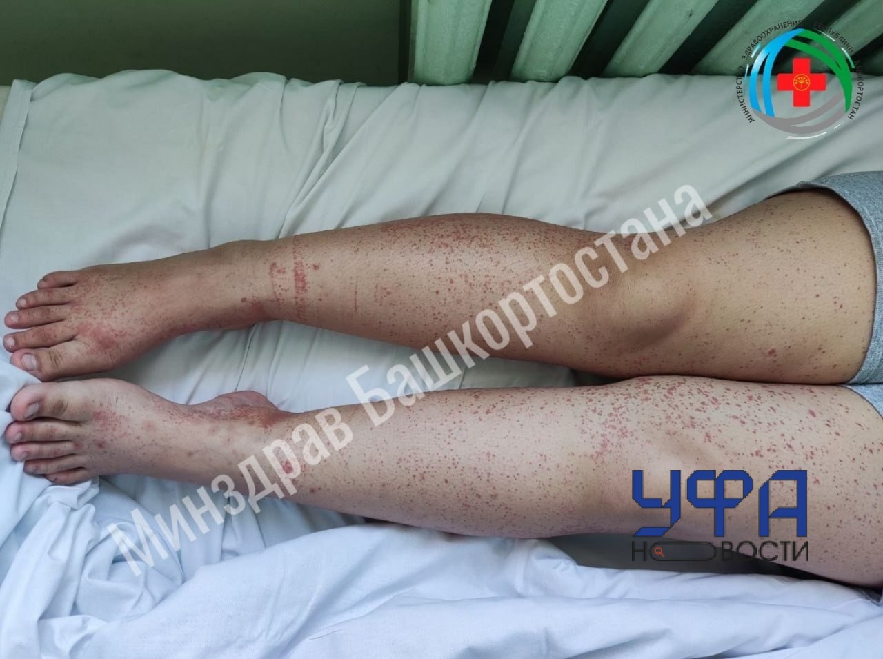 В Башкирии вылечили 12-летнюю девочку с редким заболеванием 