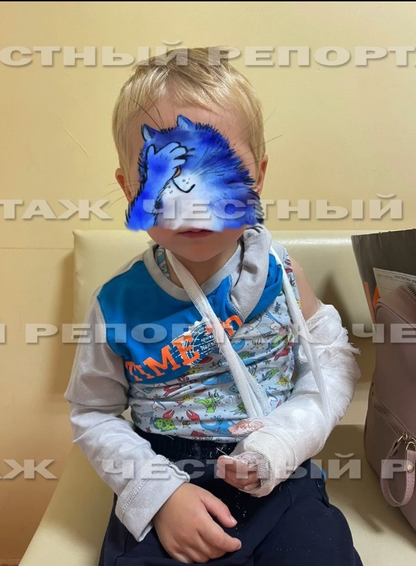  В Уфе ребенок получил двойной перелом руки в детском саду